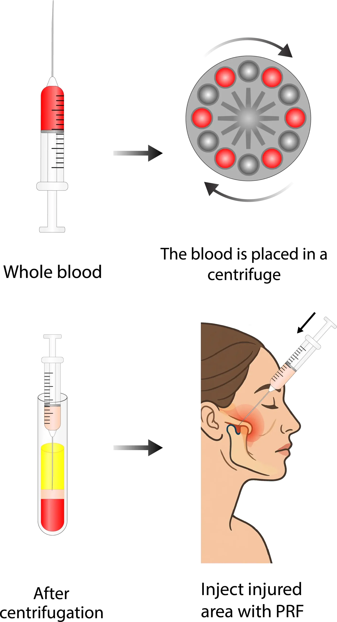 Expert PRF Injections at the TMJ & Sleep Therapy Centre of New Orleans Expert PRF Injections at the TMJ & Sleep Therapy Centre of New Orleans