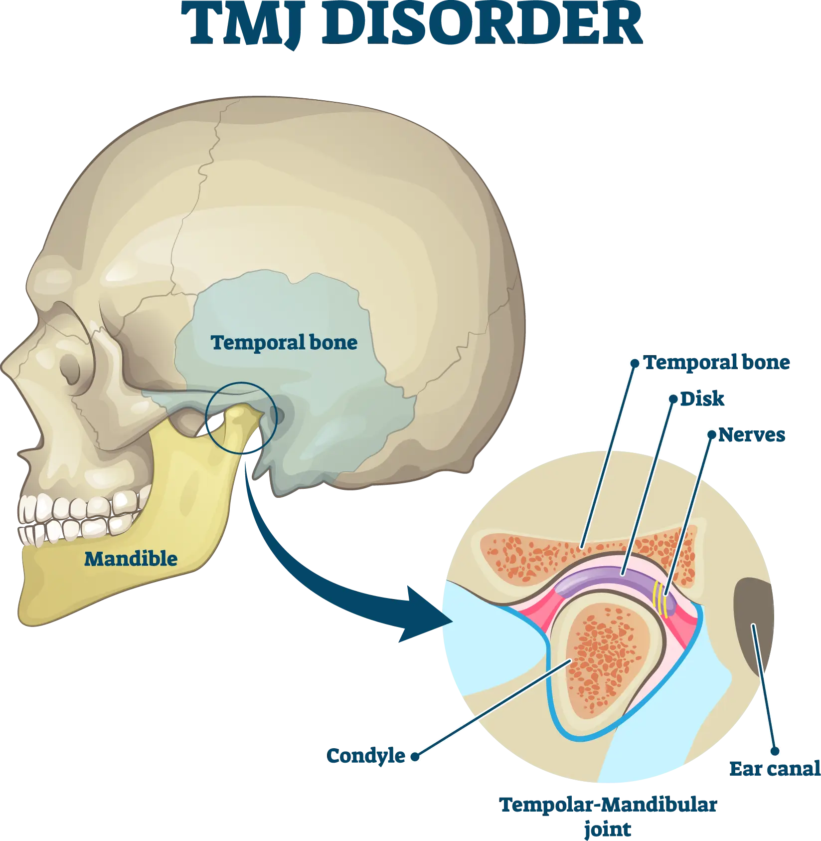 Understanding TMJ Disorder at the TMJ & Sleep Therapy Centre of New Orleans Understanding TMJ Disorder at the TMJ & Sleep Therapy Centre of New Orleans