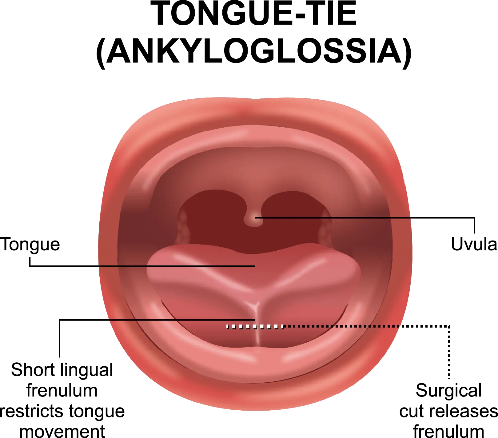 Understanding Tongue Tie at the TMJ & Sleep Therapy Centre of New Orleans Understanding Tongue Tie at the TMJ & Sleep Therapy Centre of New Orleans